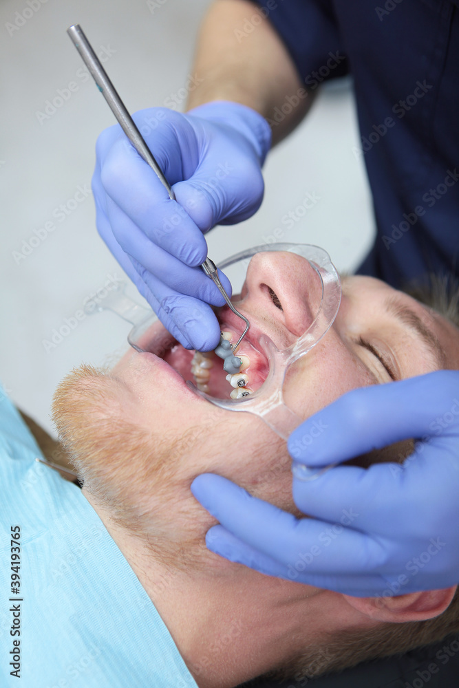 Doctor orthodontist installs braces. Macro photo of teeth correction
