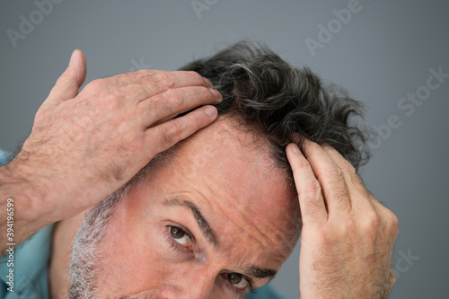 Man Checking His Hair Loss