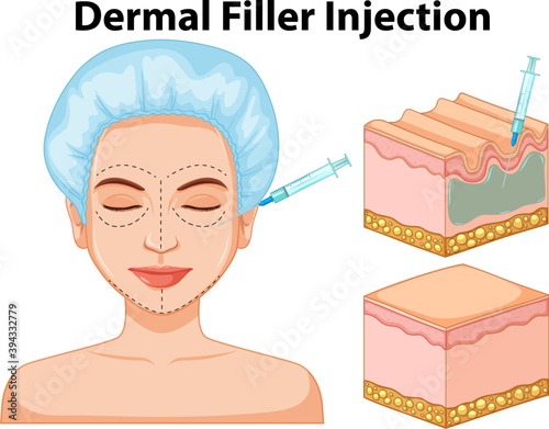 Dermal filler injection information