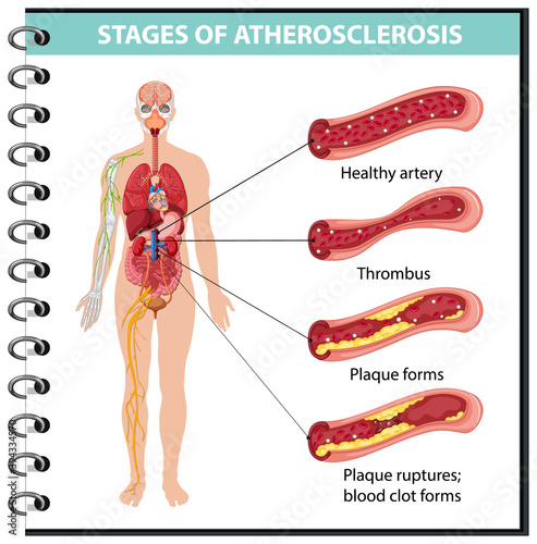Stages of atherosclerosis information infographic