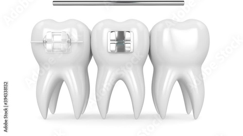 Teeth with three types of orthodontic braces
 photo