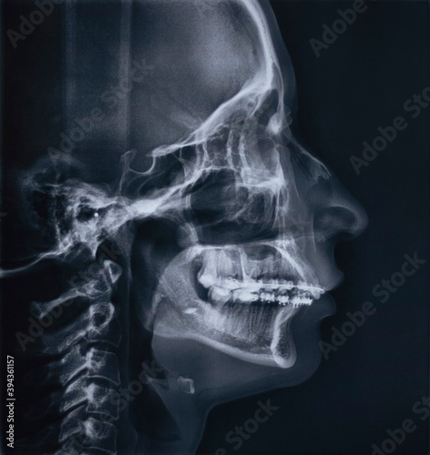 Teleroentgenographic x-ray image (TRG) of facial profile photo