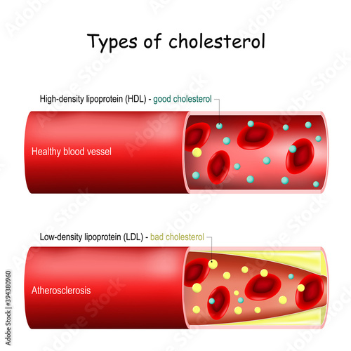 Types of cholesterol. Normal and narrowed artery