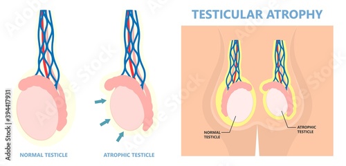 Testicular Disorder men vas pus tube male pain cyst test exam self cord vein sperm Acute blood semen tract penis viral virus tumor fluid testes pelvic sexual penile trauma system prostate testis