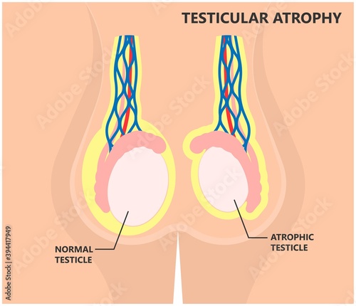 Testicular Disorder men vas pus tube male pain cyst test exam self cord vein sperm Acute blood semen tract penis viral virus tumor fluid testes pelvic sexual penile trauma system prostate testis