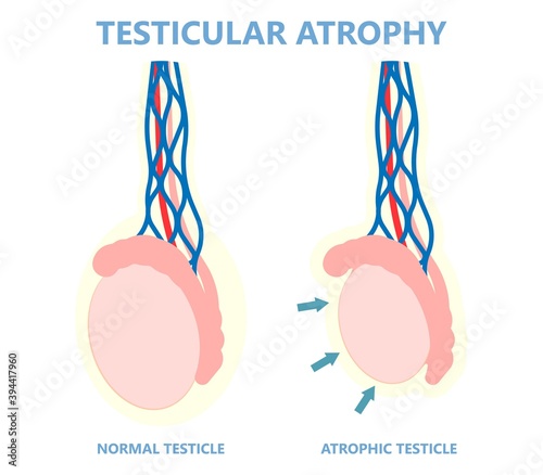 Testicular Disorder men vas pus tube male pain cyst test exam self cord vein sperm Acute blood semen tract penis viral virus tumor fluid testes pelvic sexual penile trauma system prostate testis