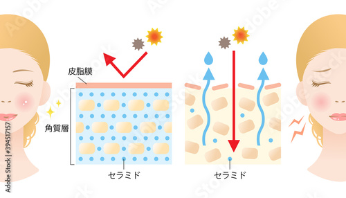 セラミド　乾燥肌　断面図　女性　ビフォアアフター