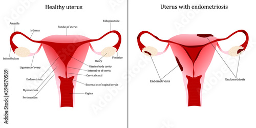 Normal uterus and uterus with endometriosis. Vector illustration
