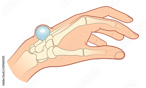 Hygroma on the hand illustration
