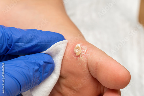 Photos Healing treatment of cracked, dry wart, calluses on the child foot sole