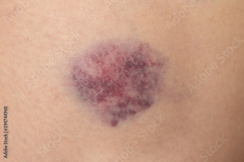 Bruise Skin Texture