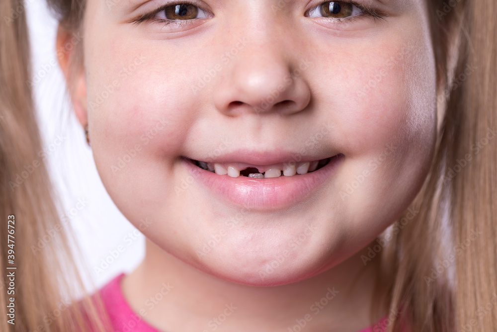 A preschool girl with her first adult incisors. The milk tooth has fallen out, and a permanent tooth grows in the open mouth. Dental hygiene concept A preschool girl with her first adult incisors. The milk tooth has fallen out, and a permanent tooth grows in the open mouth. Dental hygiene concept