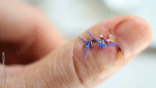 The wound and stitches on the finger are treated with antiseptic extreme close-up. Real time, contains people, trauma photo