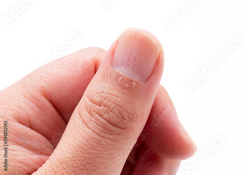 A close-up of a hangnail on a white background photo