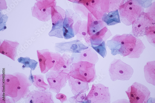 View in microscopic of Abnormal human cervix cells.Squamous epithelium cells.Superficial and intermediate epithelial cells.Cytology and pathology laboratory department.Magnification 400 X