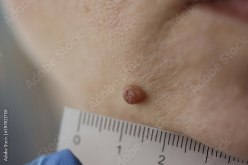 Doctor measuring size of patients pigmented nevus with ruler in clinic closeup. Diagnosis of skin tumors concept photo