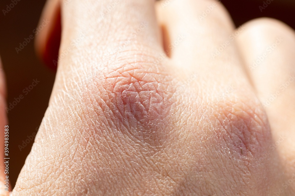 Close up of dry cracked skin on a young male hands isolated, outdoor with daylight. Pain for dehydratation. Dermatology concept. Skin texture Close up of dry cracked skin on a young male hands isolated, outdoor with daylight. Pain for dehydratation. Dermatology concept. Skin texture