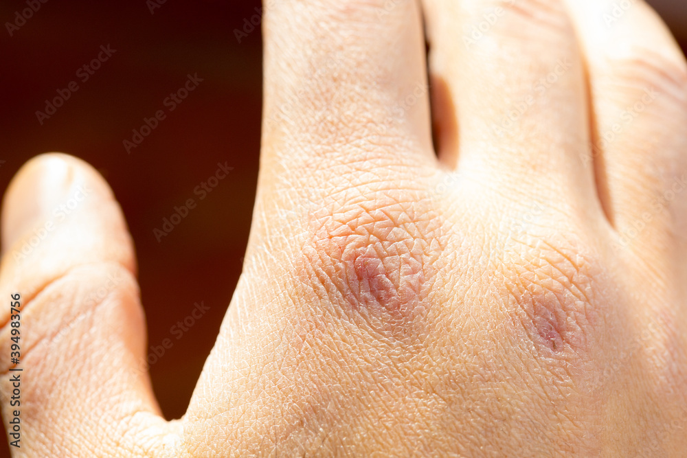 Fototapeta premium Close up of dry cracked skin on a young male hands isolated, outdoor with daylight. Pain for dehydratation. Dermatology concept. Skin texture