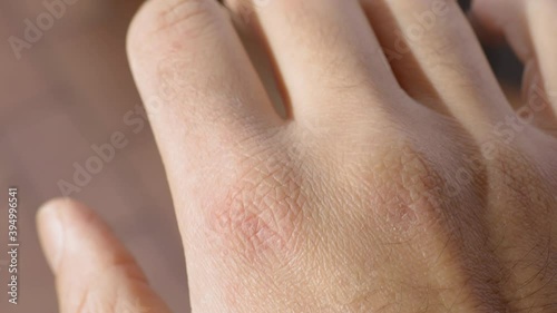 Close up of dry and cracked skin on a young male hand. Dermatology concept photo