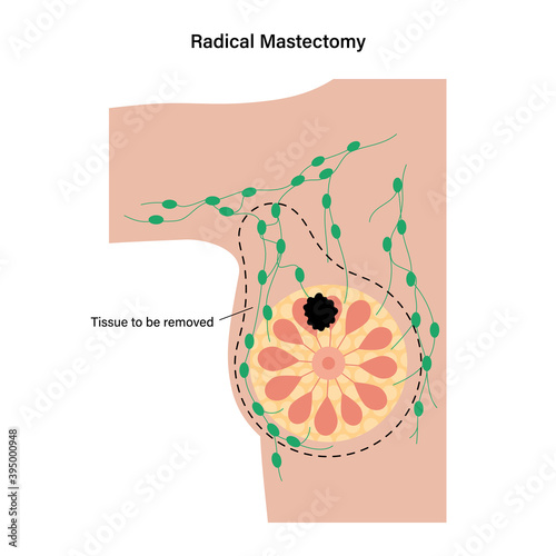 Breast disease concept