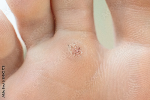 wart on a blunt close-up. Macro shot of human papilloma on the foot. photo