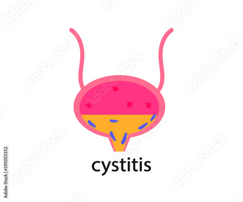 Bladder on a white background. Cystitis. Vector illustration.