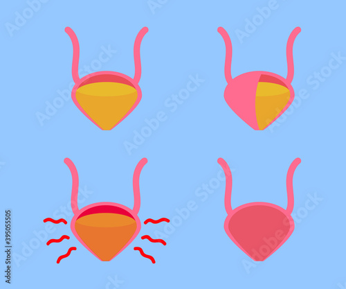 Bladder on a blue background. Cystitis. Vector illustration.