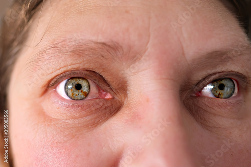 inflamed gray eyeswith spots on the iris, wrinkles on the eyelids close up, human vision concept, optic nerve health, nervous tic, myopia, hyperopia, vision test, genetic engineering