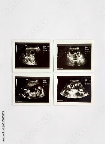 Ultrasound scans of a pregnant woman, from conception to the third trimester of pregnancy