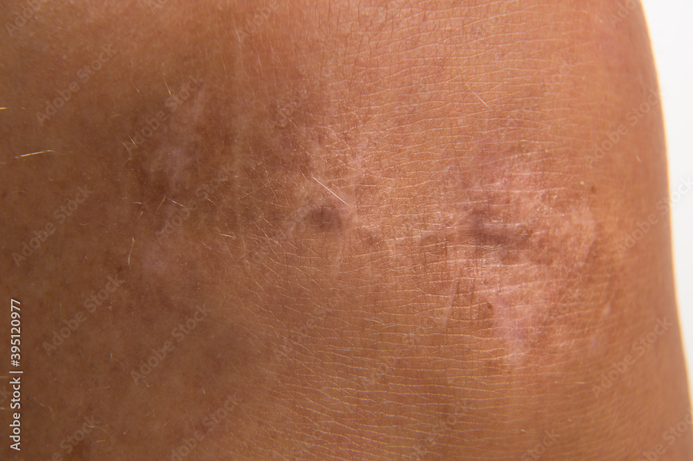 Fototapeta premium Close up scar on skin. Healed scar