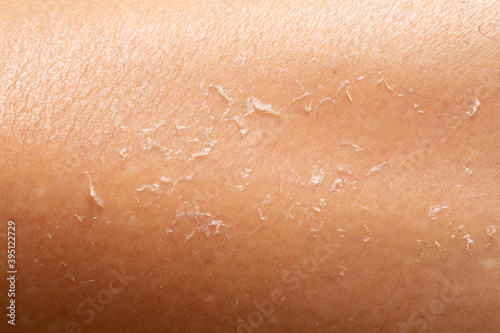 unhealthy human skin epidermis texture with flaking and cracked particles close-up