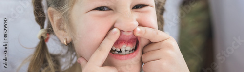 Adult permanent teeth coming in front of the child's baby teeth: shark teeth.