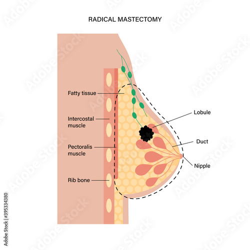Breast disease concept