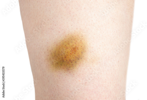 Close-up of bruise of hitting in the leg of woman on white background