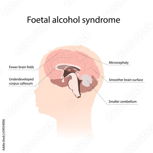 Illustration showing the effects of foetal alcohol syndrome on the brain. With explanations.