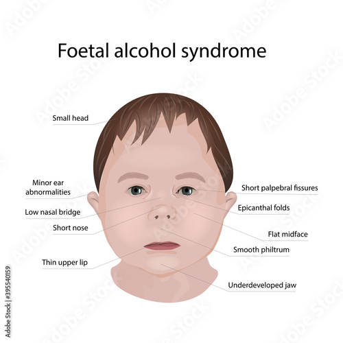 Illustration showing the effects of foetal alcohol syndrome on a child's face. With explanations.