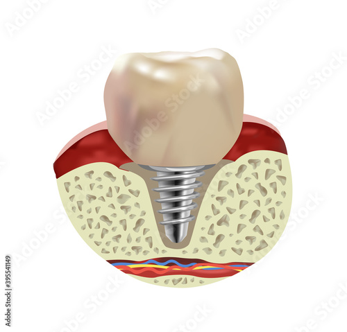 Artificial human tooth implant, cross section realistic view, vector illustration