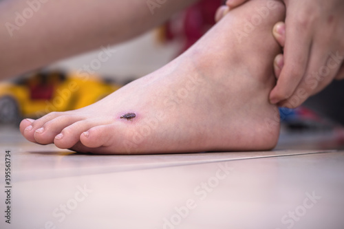 child s foot  boy with wound  injured foot