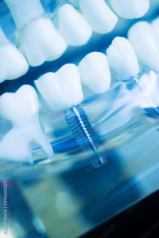 Dental tooth implant model