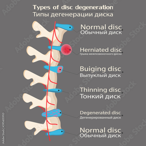 spinal disc degeneration illustration, educational medical illustration, spine disease options, flat style, idea for your decoration, vector image