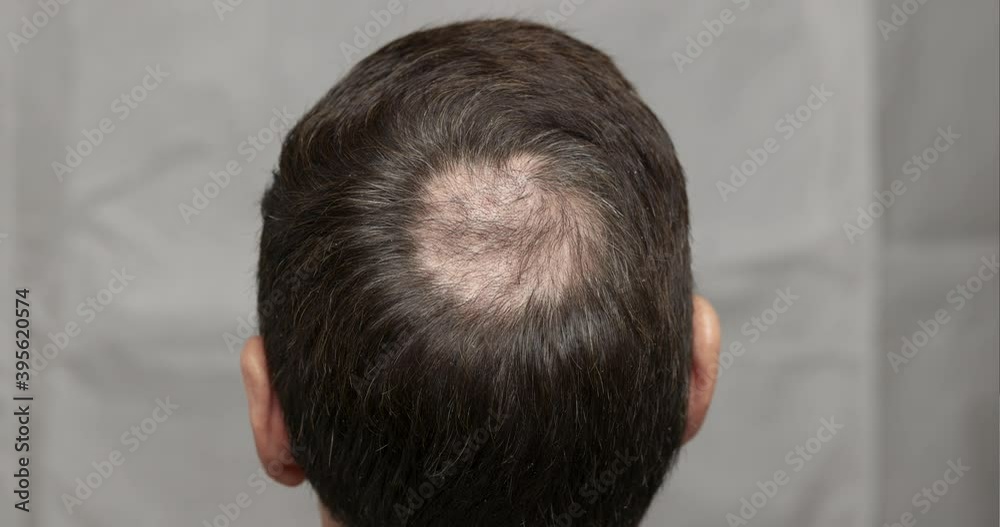 Man with hair loss problems close-up. Alopecia balding hairs on man scalp. Human alopecia or hair loss - adult person hand pointing his bald head. Scratching his head. Baldness. Depression. Man with hair loss problems close-up. Alopecia balding hairs on man scalp. Human alopecia or hair loss - adult person hand pointing his bald head. Scratching his head. Baldness. Depression.