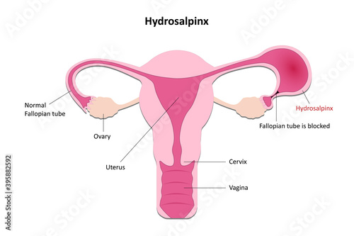Hydrosalpinx diagram, Obstructed Follopian tube, Infection or membrane covering the fallopian tube cause blockage