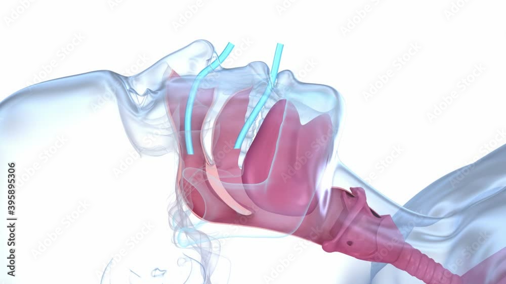 Sleep apnea syndrome. Labeled nasal tongue blocked airway, 3D animation