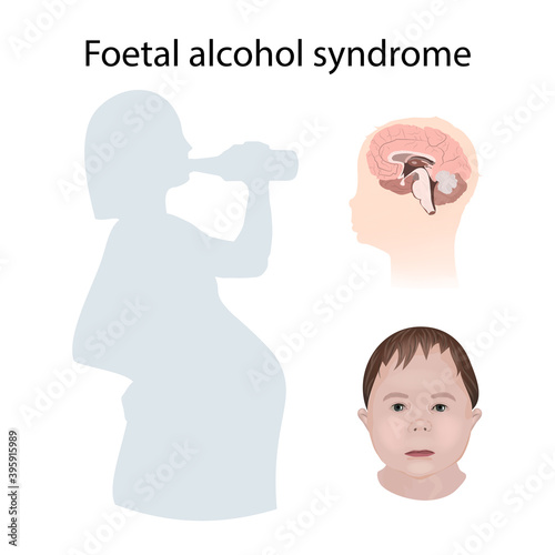 Illustration showing the effects of foetal alcohol syndrome on the brain and on a child's face. Drinking pregnant woman.