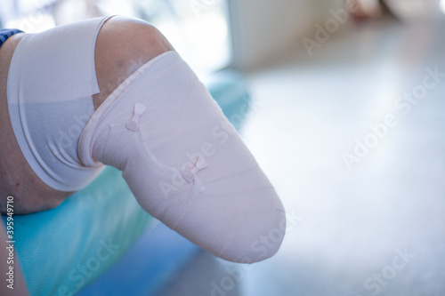 Below knee amputation bandaging