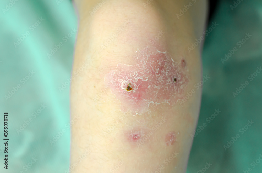 Healing wounds on the knee of a child. Healing wounds on the knee of a child.