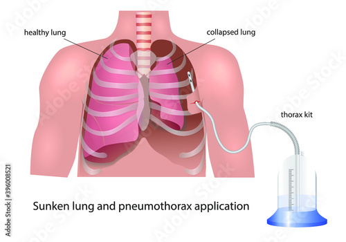 Health concept. Sunken lung and administration of pneumothorax