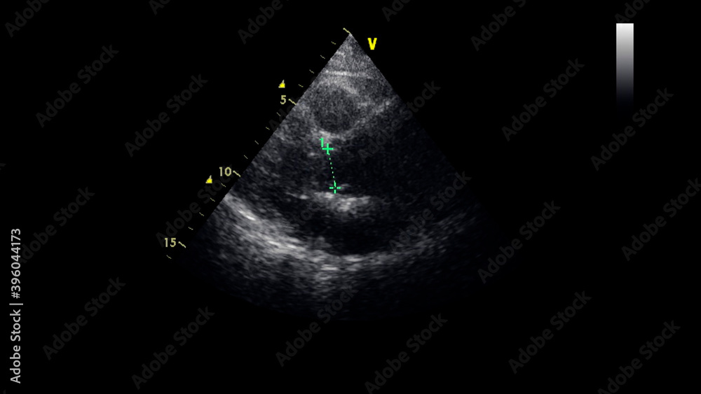 Obraz premium Image of the heart in gray-scale mode during transesophageal ultrasound.