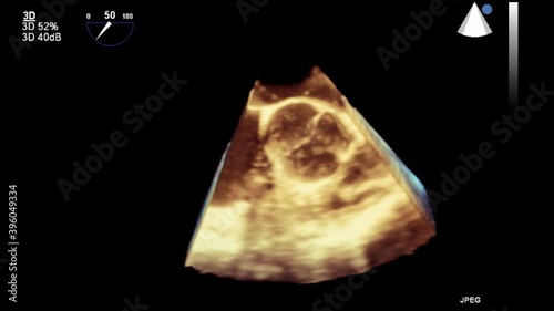 Transesophageal ultrasound video in 3D mode.