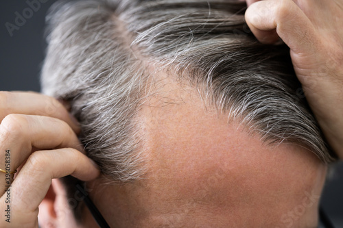 Balding Man Losing Hair